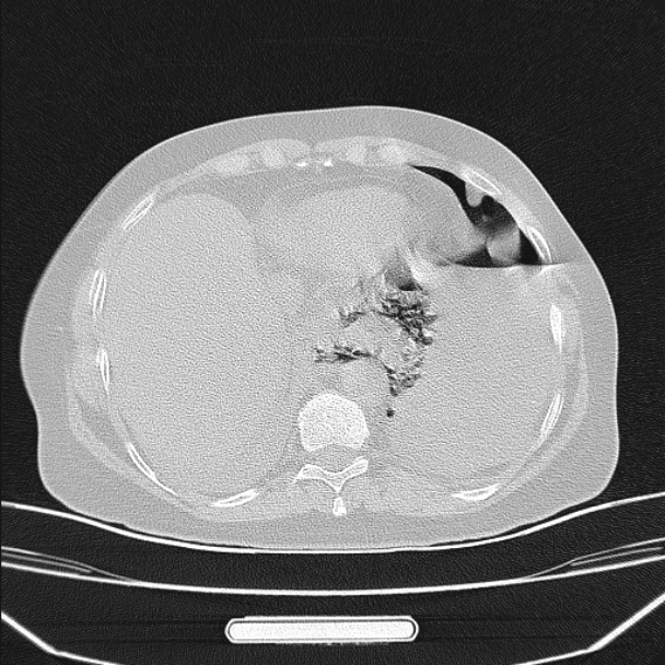 Boerhaave syndrome (Radiopaedia 45644-49799 Axial lung window 91).jpg