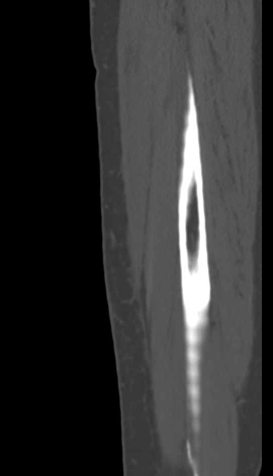 Bone metastasis - tibia (Radiopaedia 57665-64609 Sagittal bone window 169).jpg