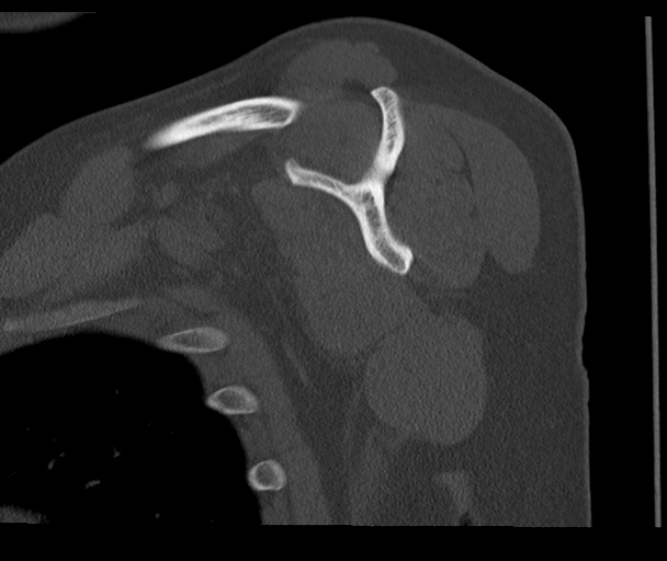 Bony Bankart and Hill-Sachs lesions (Radiopaedia 33622-34727 Sagittal bone window 38).png