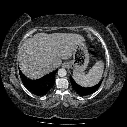 Bovine aortic arch - right internal mammary vein drains into the superior vena cava (Radiopaedia 63296-71875 A 143).jpg