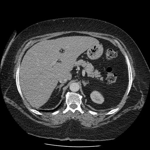 Bovine aortic arch - right internal mammary vein drains into the superior vena cava (Radiopaedia 63296-71875 A 177).jpg
