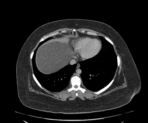 Bowel and splenic infarcts in acute lymphocytic leukemia (Radiopaedia 61055-68913 A 16).jpg