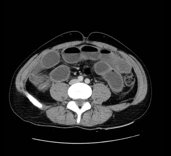 Bowel obstruction from colon carcinoma (Radiopaedia 22995-23028 A 53).jpg