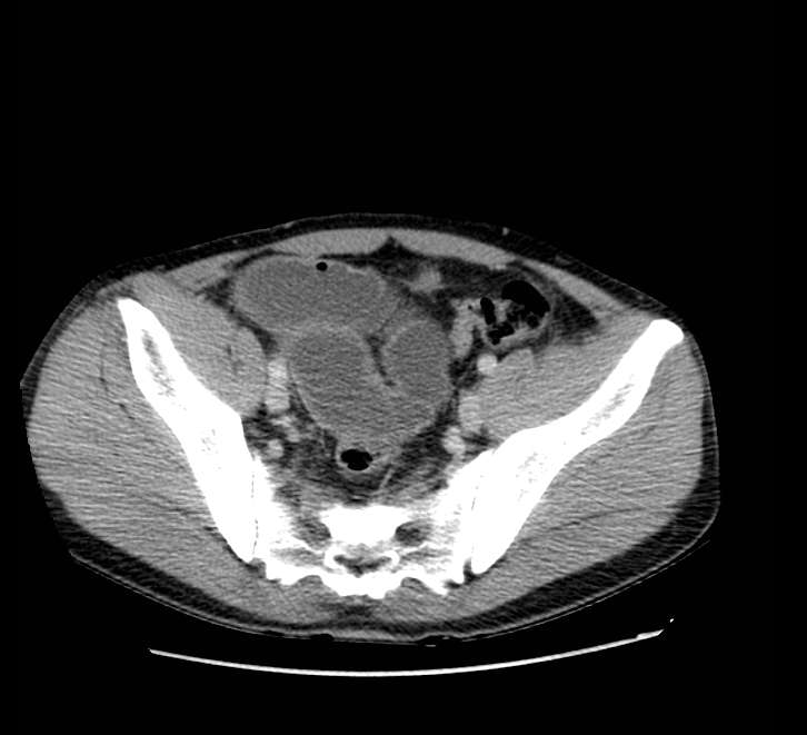 Bowel obstruction from colon carcinoma (Radiopaedia 22995-23028 A 70).jpg