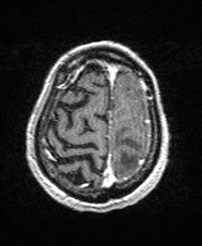 Brain abscess with dual rim sign (Radiopaedia 87566-103938 Axial T1 C+ 139).jpg