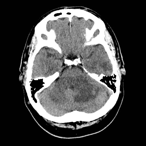 File:Brain metastases from lung cancer (Radiopaedia 83839-99027 Axial non-contrast 9).jpg