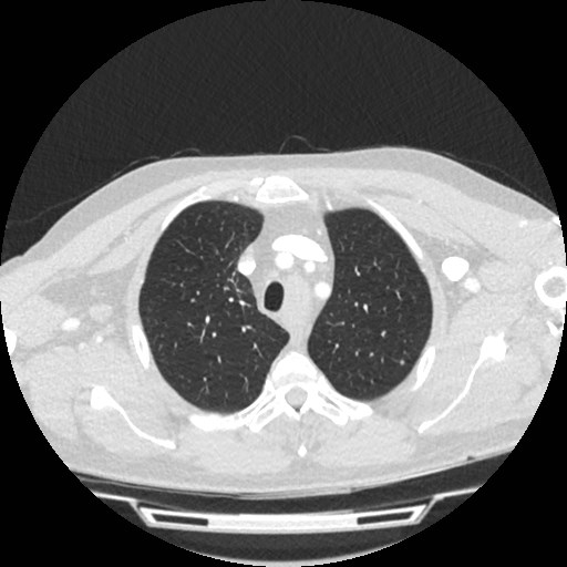 File:Brain metastases from lung cancer (Radiopaedia 83839-99030 Axial lung window 2).jpg