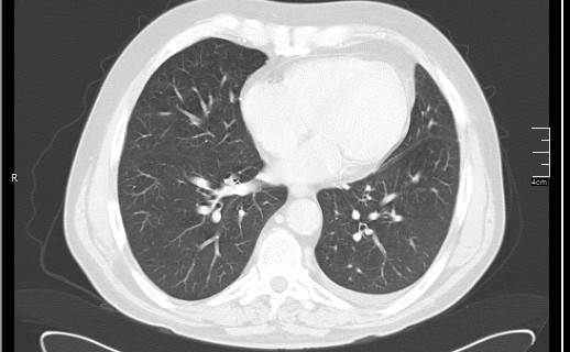 Brain metastases from squamocellular lung cancer (Radiopaedia 56515-63219 Axial lung window 43).jpg