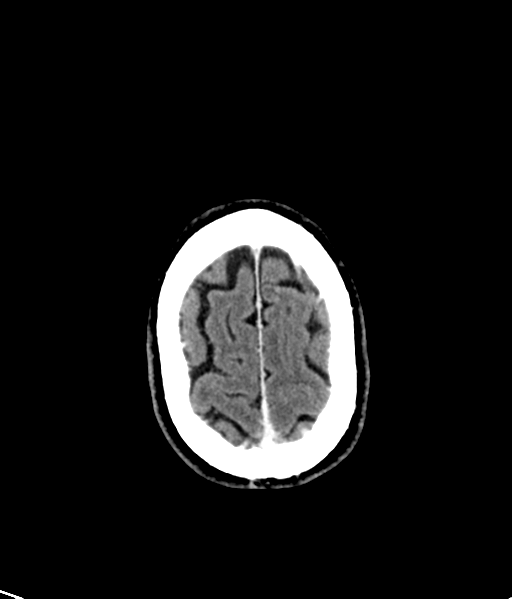 File:Brain metastasis (large cystic mass) (Radiopaedia 47497-52106 Axial C+ 51).png