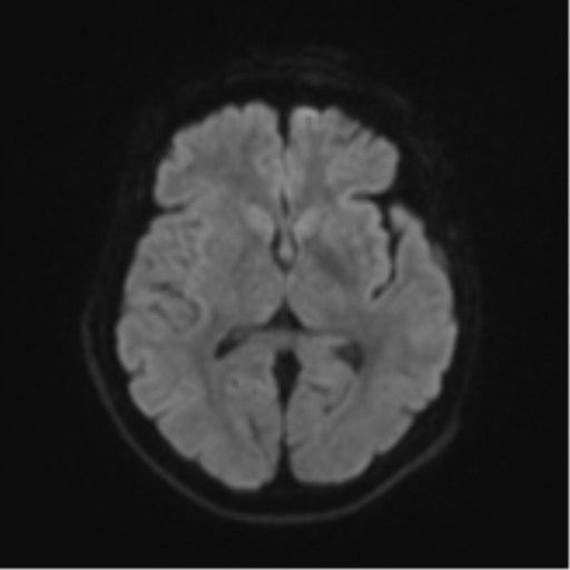 Brain metastasis (sarcoma) (Radiopaedia 47576-52209 Axial DWI 42).png