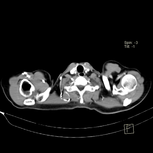 Brain metastasis as initial presentation of non-small cell lung cancer (Radiopaedia 65122-74127 A 1).jpg