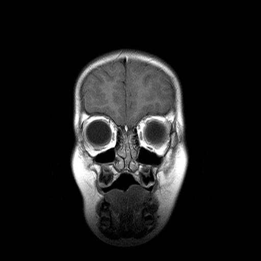 File:Brainstem ganglioglioma (Radiopaedia 10763-11224 Coronal T1 C+ 17).jpg