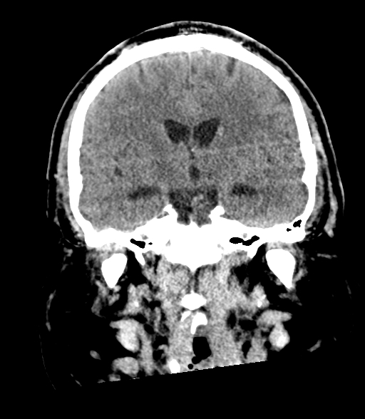File:Brainstem hemorrhage (Radiopaedia 81294-94976 Coronal non-contrast 34).jpg