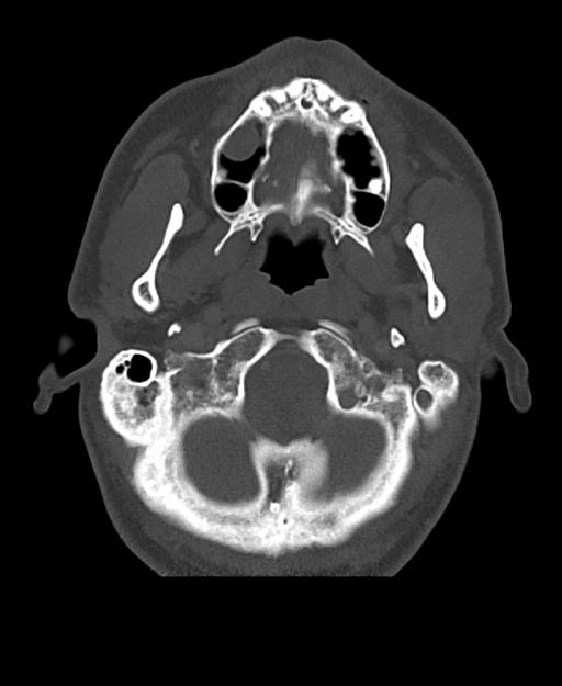 Branchial cleft cyst (Radiopaedia 31167-31875 Axial bone window 14).jpg