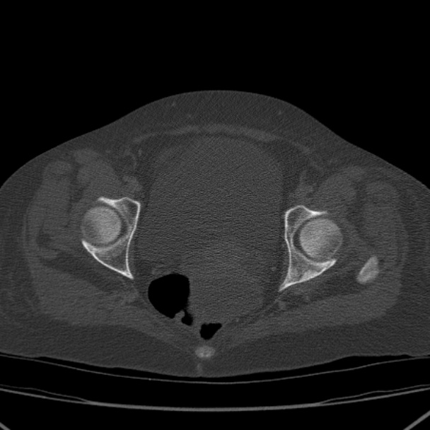 Breast cancer metastases - hepatic and skeletal (Radiopaedia 34201-35461 Axial bone window 101).jpg