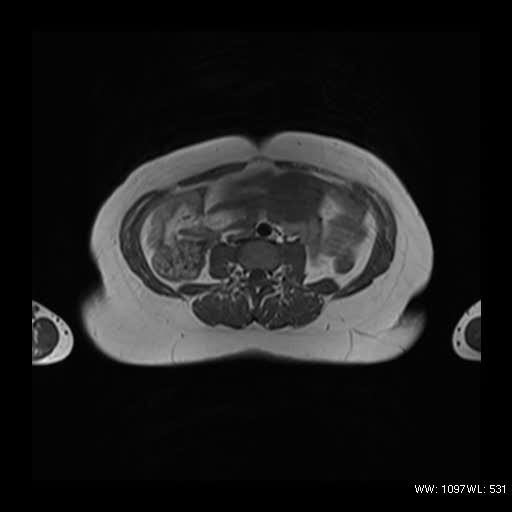 File:Broad ligament fibroid (Radiopaedia 49135-54241 Axial T1 2).jpg
