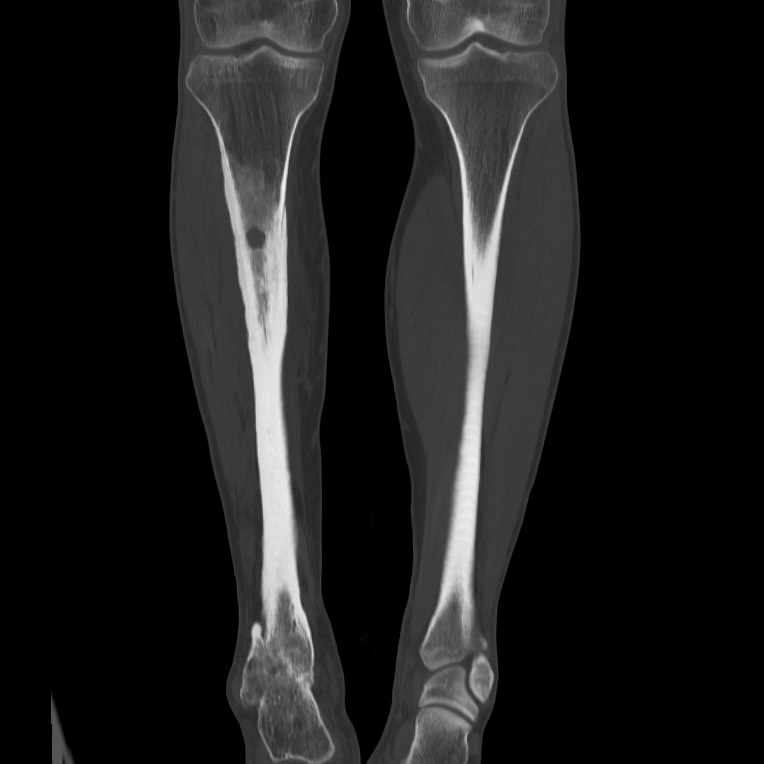 Brodie abscess - tibia (Radiopaedia 66028-75204 Coronal bone window 33).jpg