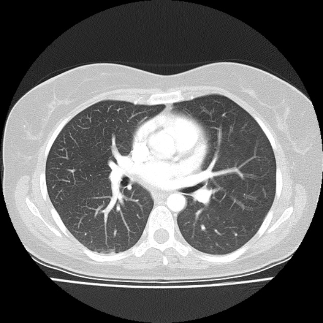 Bronchial atresia (Radiopaedia 22965-22992 Axial lung window 27).jpg