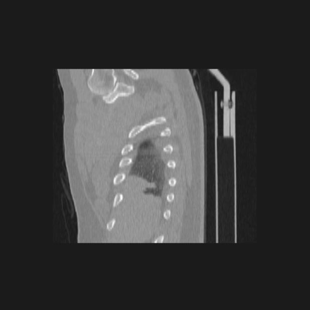 Bronchial atresia (Radiopaedia 60685-68439 Sagittal lung window 4).jpg