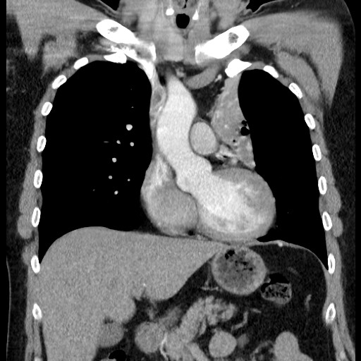 Bronchial carcinoid tumor (Radiopaedia 67377-76764 C 30).jpg