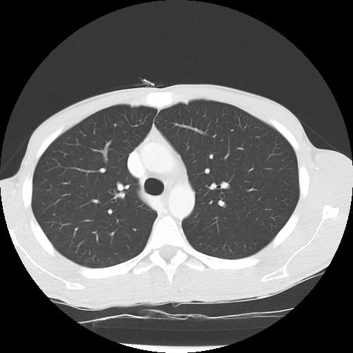 Bronchial carcinoid tumor causing right lower lobe collapse (Radiopaedia 83495-98594 Axial lung window 15).jpg