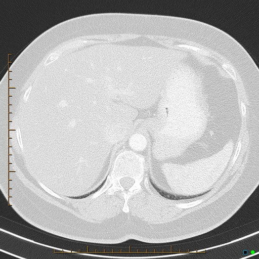 Bronchial diverticula (Radiopaedia 79512-92675 Axial lung window 46).jpg