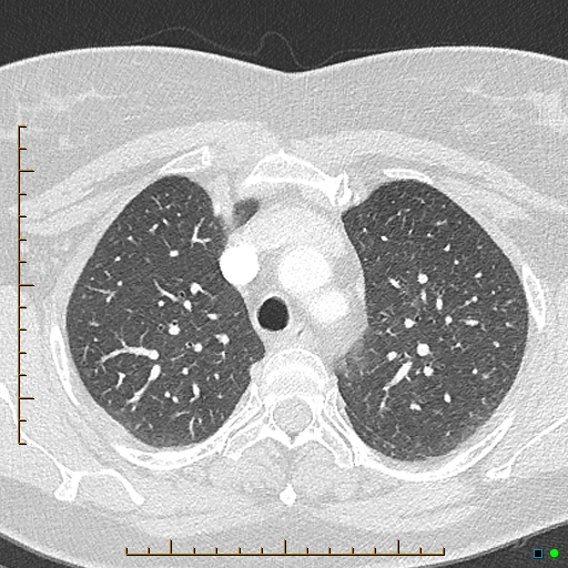 File:Bronchial diverticula (Radiopaedia 79512-92676 Axial lung window 43).jpg