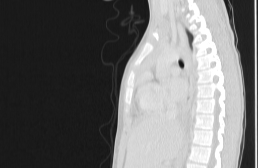 Bronchial mucoepidermoid carcinoma (Radiopaedia 57023-63895 Sagittal lung window 90).jpg