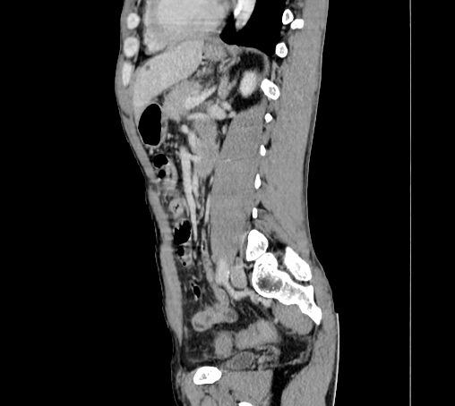 File:Bronchiectasis in Crohn disease (Radiopaedia 60311-67977 D 71).jpg