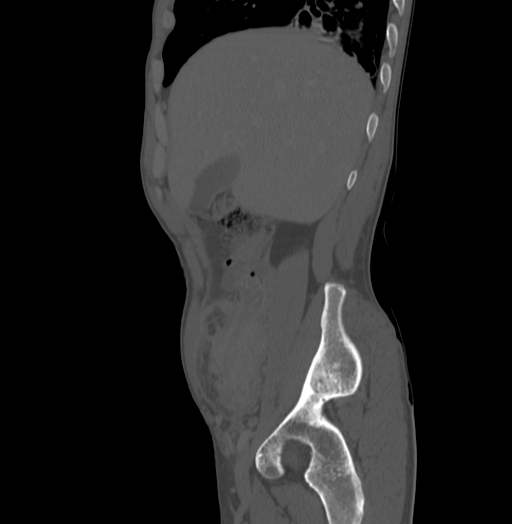 Bronchiectasis in Crohn disease (Radiopaedia 60311-67977 Sagittal bone window 43).jpg