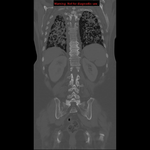 File:Bronchoalveolar carcinoma (Radiopaedia 13224-13233 Coronal non-contrast 21).jpg