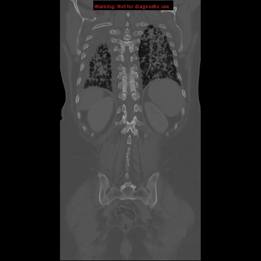 File:Bronchoalveolar carcinoma (Radiopaedia 13224-13233 Coronal non-contrast 25).jpg