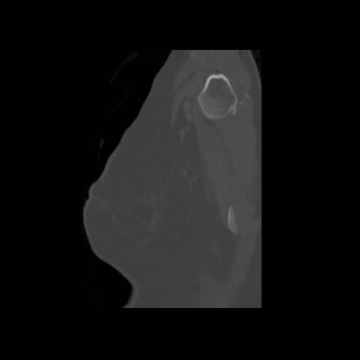 Bronchogenic carcinoma (Radiopaedia 73497-84262 Sagittal bone window 147).jpg