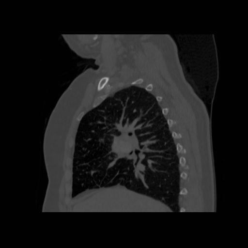 Bronchogenic carcinoma (Radiopaedia 73497-84262 Sagittal bone window 65).jpg