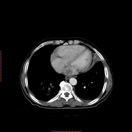 File:Bronchogenic carcinoma with left atrial large deposit - T4N3M1a (Radiopaedia 42316-45428 A 21).jpg