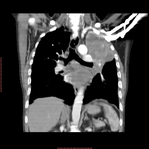 File:Bronchogenic carcinoma with left atrial large deposit - T4N3M1a (Radiopaedia 42316-45428 B 10).jpg