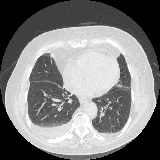 File:Bronchogenic carcinoma with metastatic lymphadenopathy (Radiopaedia 37671-39569 Axial lung window 37).jpg