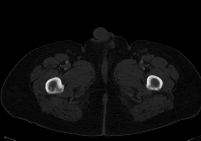 Brown tumors compressing the spinal cord (Radiopaedia 68442-77988 G 144).jpg