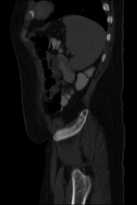 Brown tumors compressing the spinal cord (Radiopaedia 68442-77988 H 47).jpg