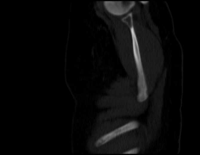 Brown tumors compressing the spinal cord (Radiopaedia 68442-77988 Sagittal bone window 5).jpg