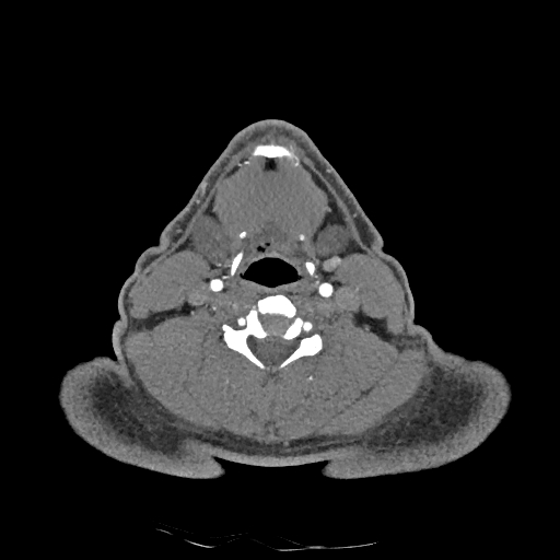 Buccal fat pad arteriovenous malformation (Radiopaedia 70936-81144 D 128).jpg