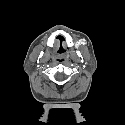 Buccal fat pad arteriovenous malformation (Radiopaedia 70936-81144 D 205).jpg