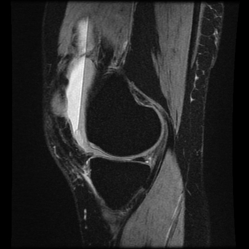 Bucket handle meniscus tear (Radiopaedia 56916-63751 H 59).jpg