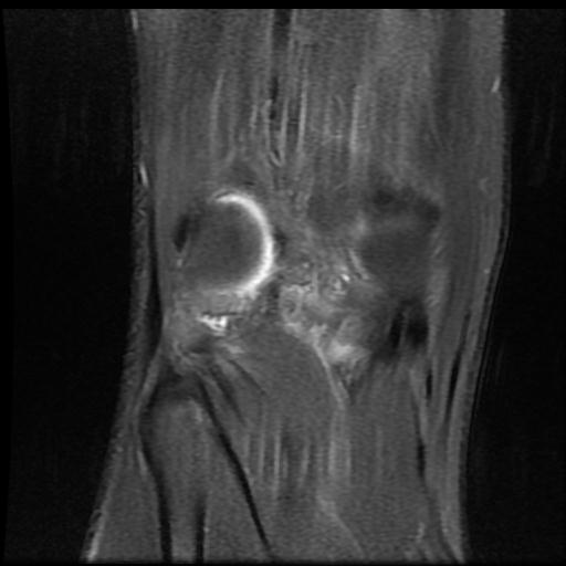 File:Bucket handle tear - medial meniscus (Radiopaedia 69245-79026 Coronal PD fat sat 17).jpg