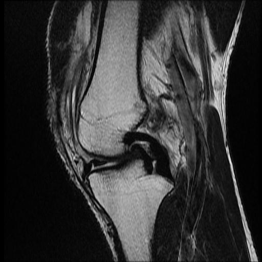 File:Bucket handle tear - medial meniscus (Radiopaedia 69245-79026 Sagittal T2 10).jpg