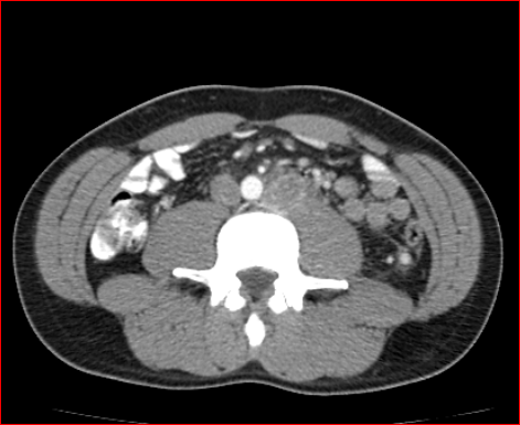 File:Burned-out testicular choriocarcinoma (Radiopaedia 32822-34040 B 15).PNG