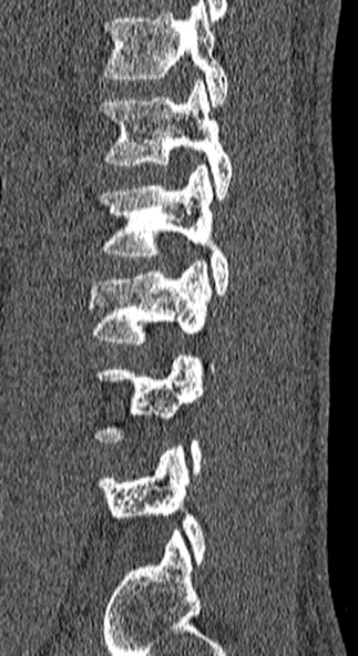 Burst fracture (Radiopaedia 53373-59357 Sagittal bone window 16).jpg