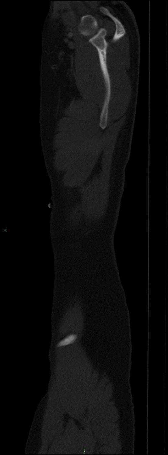 Burst fracture (Radiopaedia 83168-97542 Sagittal bone window 114).jpg