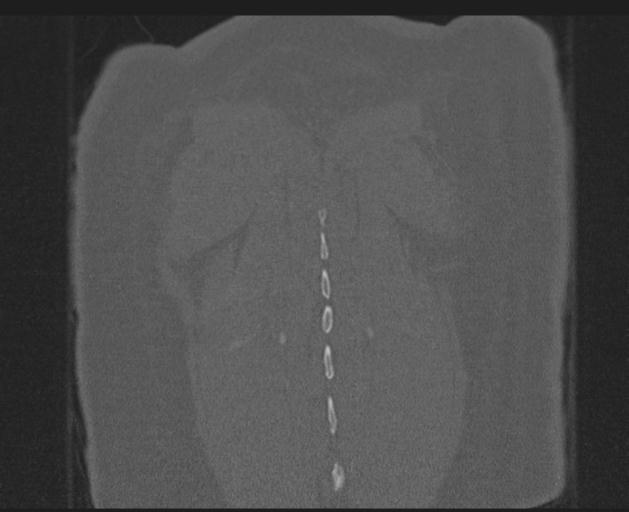 Burst fracture - thoracic spine (Radiopaedia 30238-30865 Coronal bone window 150).jpg