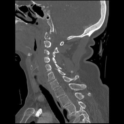 File:C1 anterior arch (plough) fracture - type 1 (Radiopaedia 76181-87720 Sagittal bone window 52).jpg